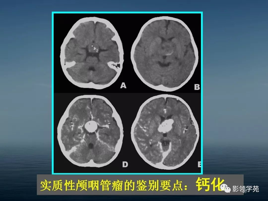 鞍区病变的ctmri诊断