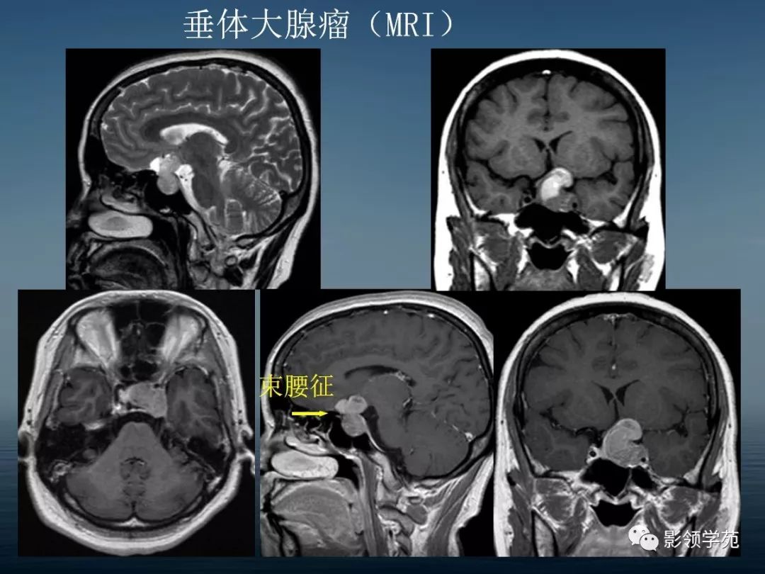 鞍区病变的ctmri诊断