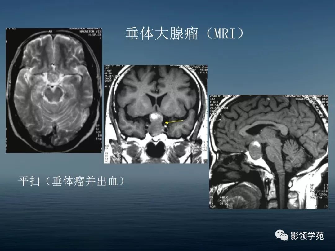 鞍区病变的ct,mri诊断