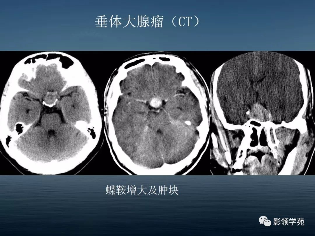 鞍区病变的ctmri诊断