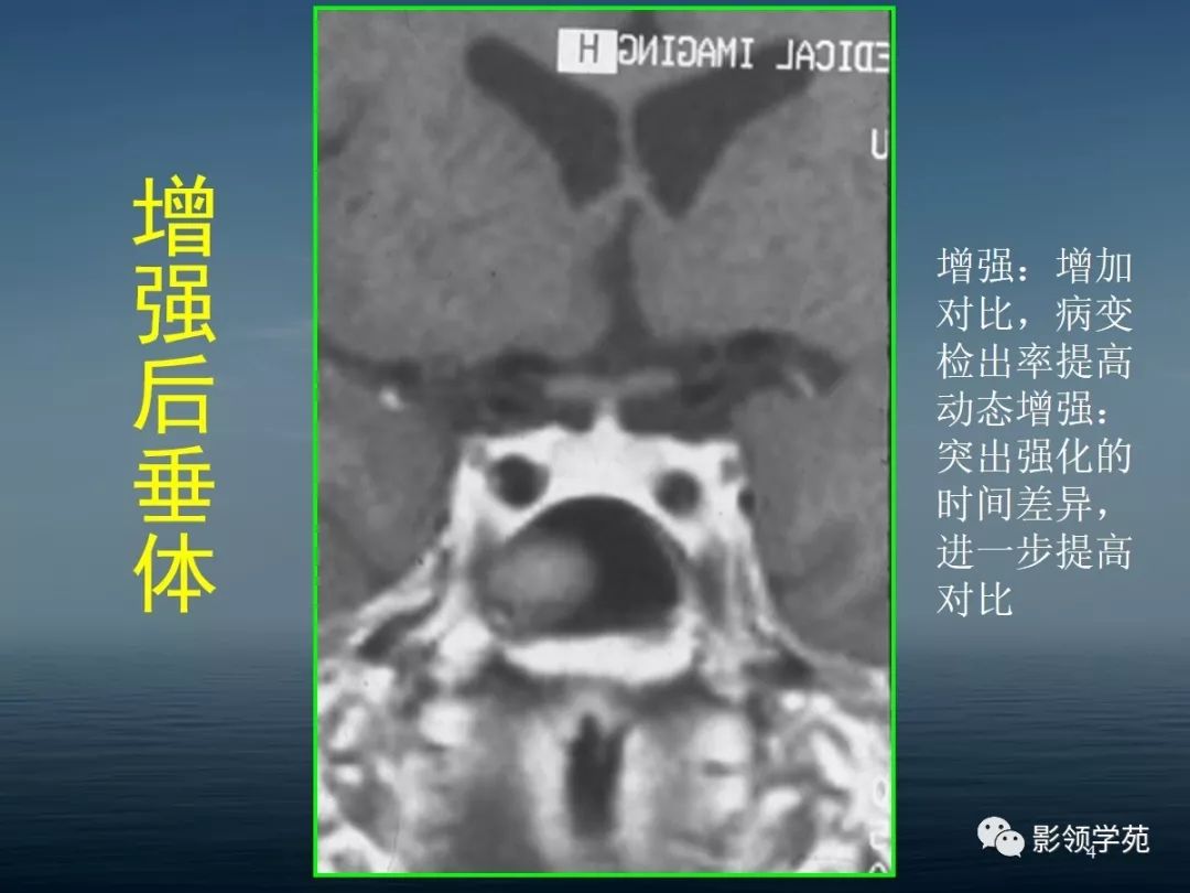 鞍区病变的ctmri诊断