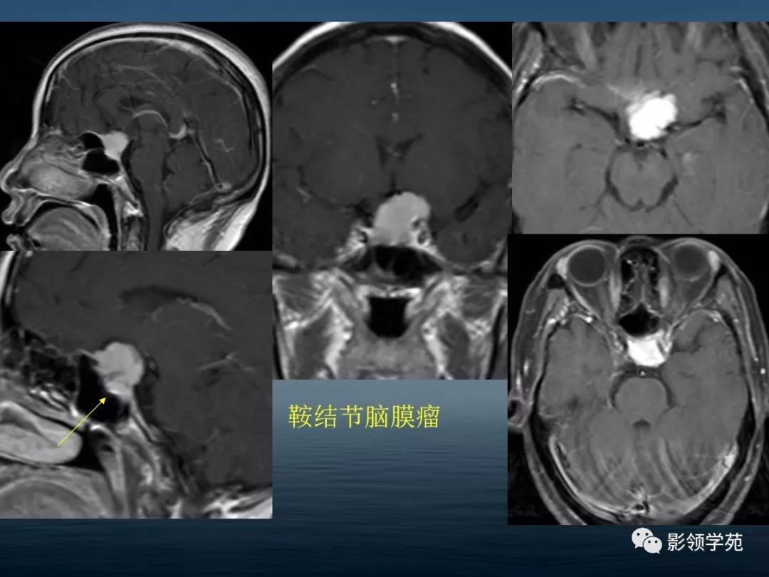 鞍区病变的ctmri诊断