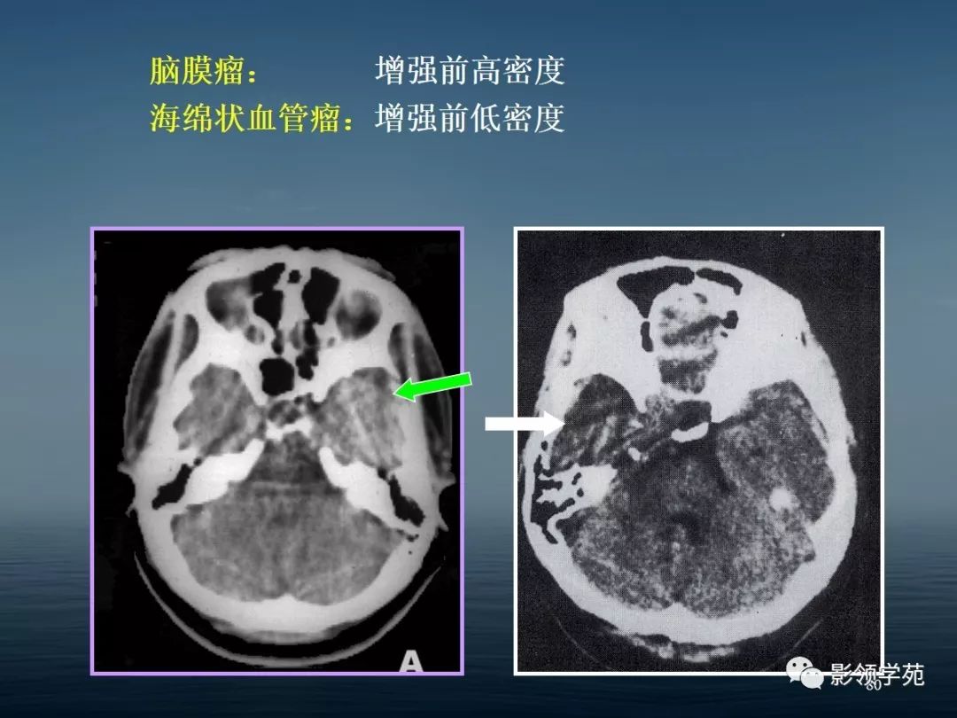 鞍区病变的ctmri诊断