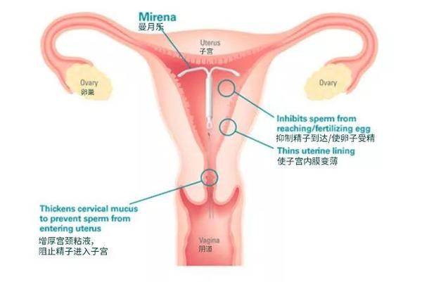 上环是什么原理放在什么地方_上环是什么原理图片(3)