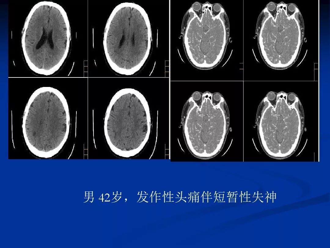 实用课件| 烟雾病的影像学诊断