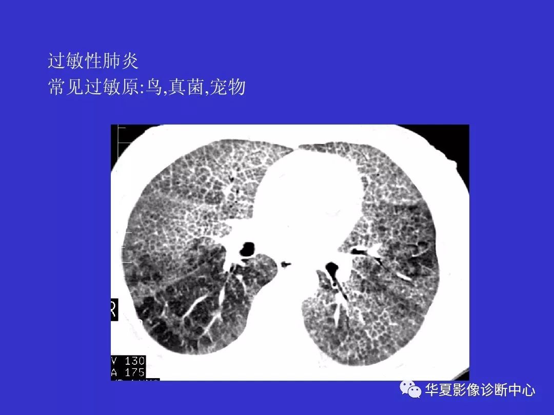 间质性肺疾病ct诊断