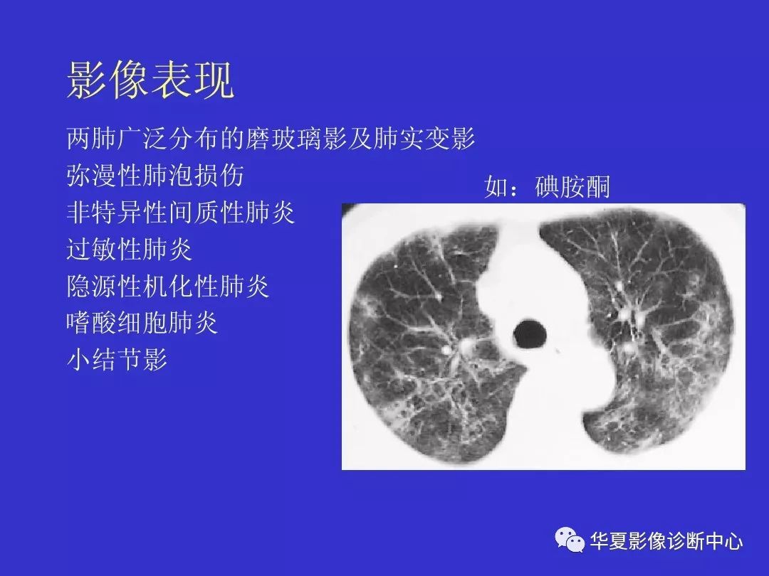 间质性肺疾病ct诊断