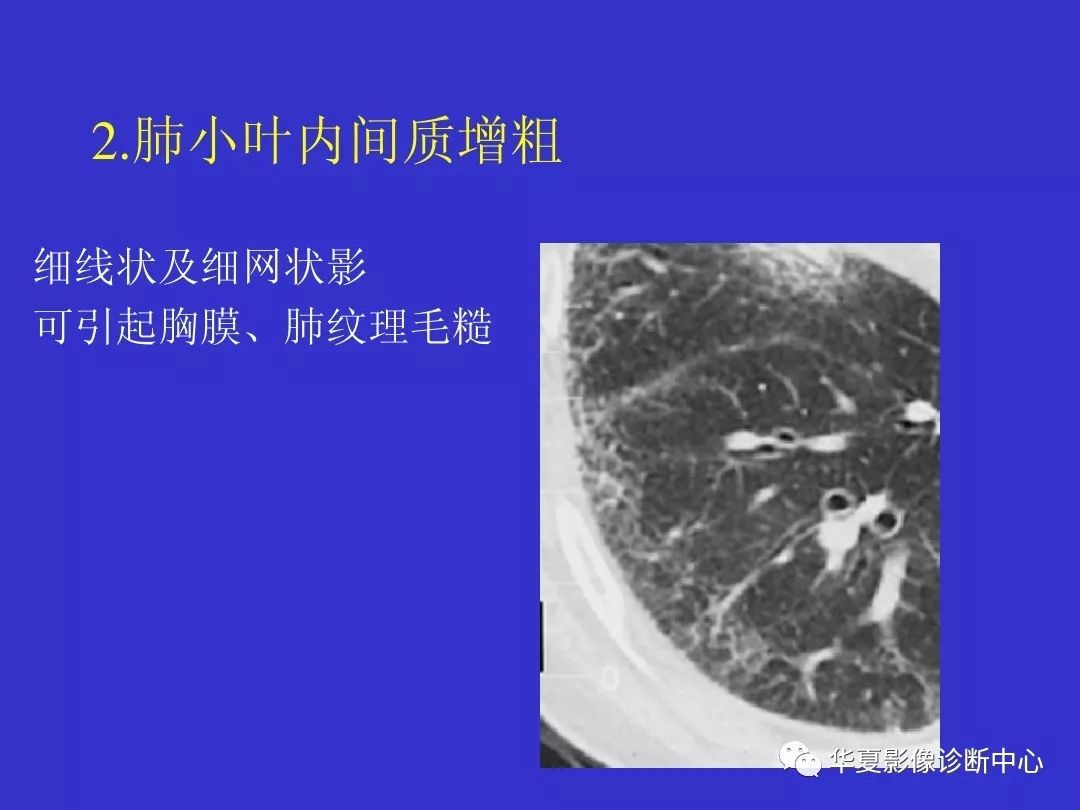 间质性肺疾病ct诊断