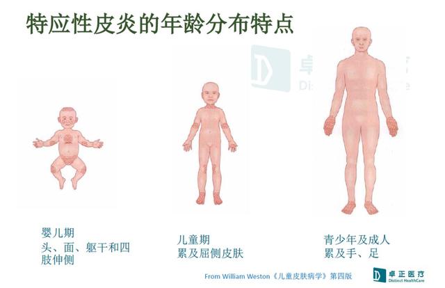 「母婴之声」宝宝得了湿疹，宝爸宝妈该如何护理最有效？