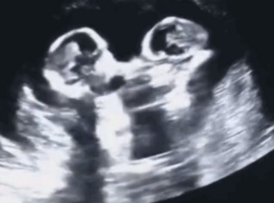 双胎孕妇做产检，胎儿宫内掐架，医护：长大不得了