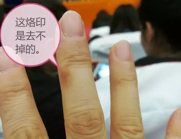 3.右手食指和中指的第一个关节都有些歪斜.