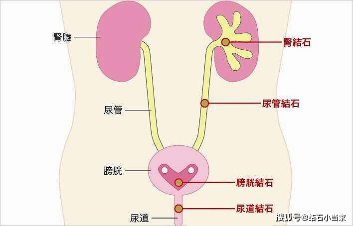 肾结石是因为什么原因引起 4cabd4c4419a4af699a3e0c714b27542.jpeg