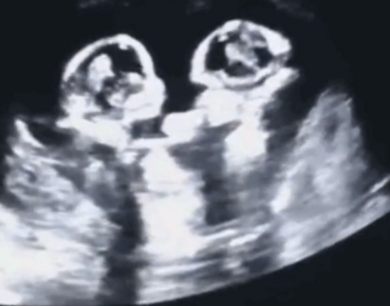 双胎孕妇做产检，胎儿宫内掐架，医护：长大不得了