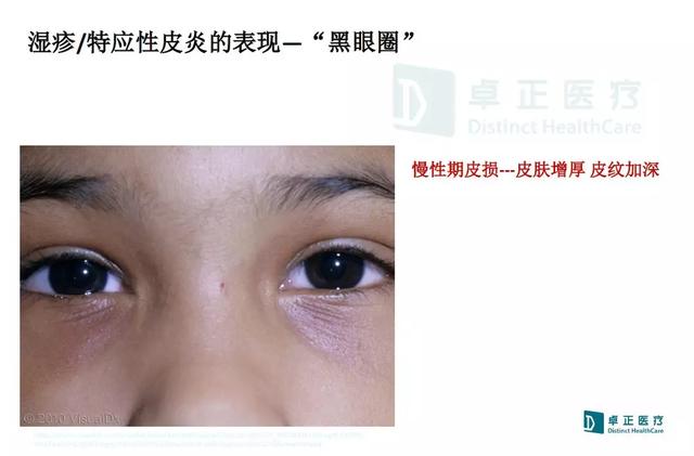 「母婴之声」宝宝得了湿疹，宝爸宝妈该如何护理最有效？