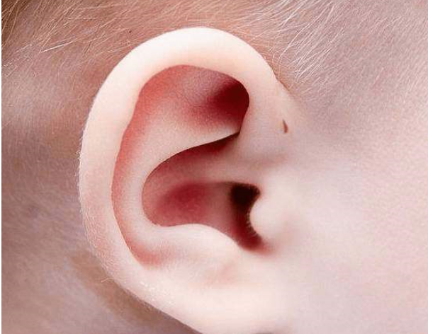 这个是先天性的,也叫做耳前瘘管,算是先天性发育不全产生的.
