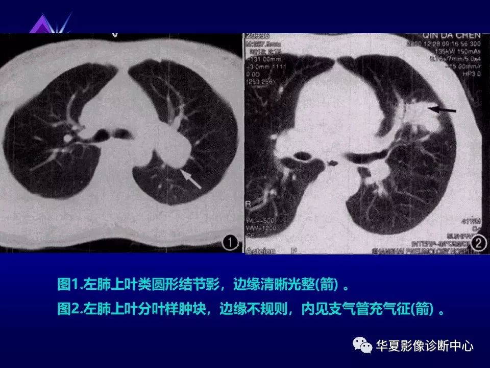 肺部"特殊"病变的影像表现