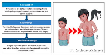 ejcts:早期手术可能改善漏斗胸患儿的心理行为异常