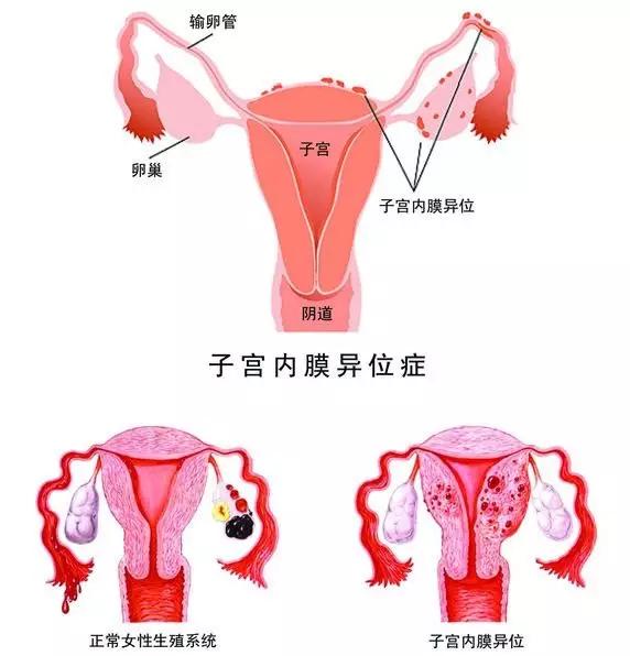 (正常子宫和子宫内膜异位症的子宫对比) no.