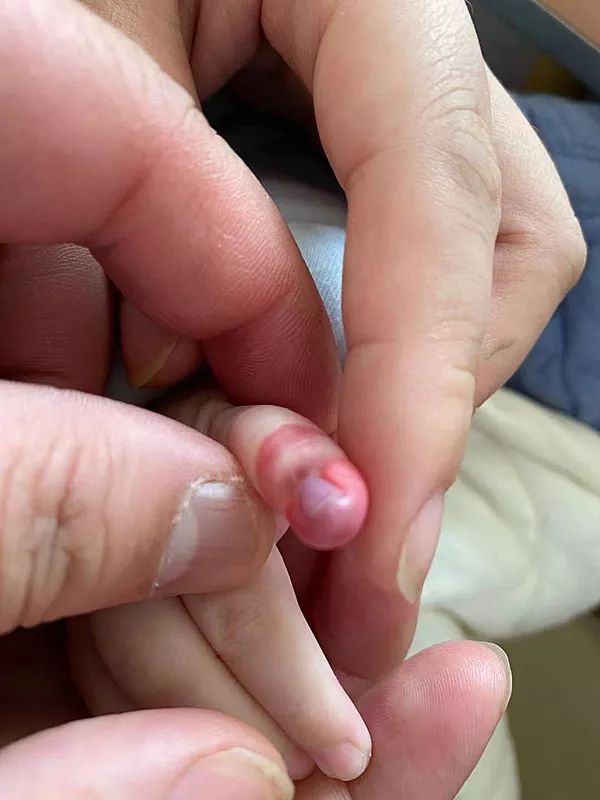 小指坏死发黑,5个月宝宝面临截肢,原因让人
