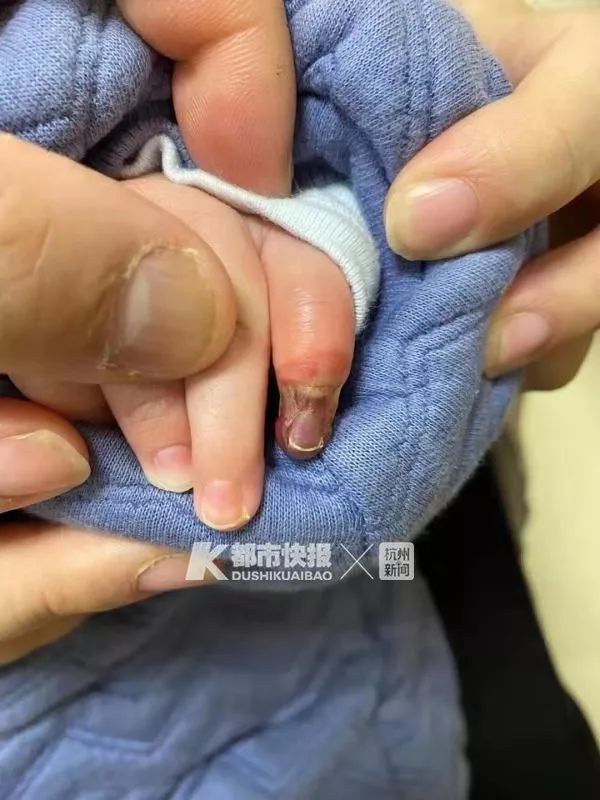 5个月大宝宝因为一根橡皮筋,差点要截肢!_小手指头