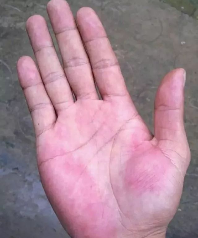 手掌发红多湿热 在自然光下观看手掌的颜色,如果手掌整体出现发红的