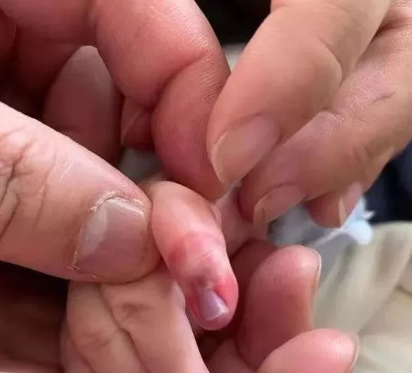 5个月大宝宝因为一根皮筋差点要截肢这件事情家长千万注意