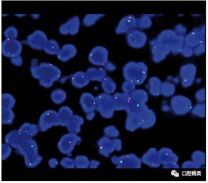 荧光原位杂交技术(fish)检测到myc基因分离重排( )