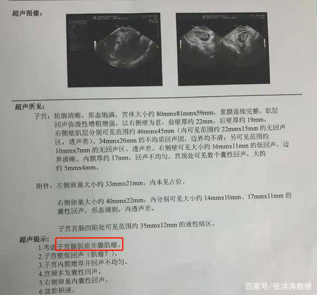 子宫腺肌症,子宫腺肌瘤和子宫肌瘤,这3个是同一种病吗?