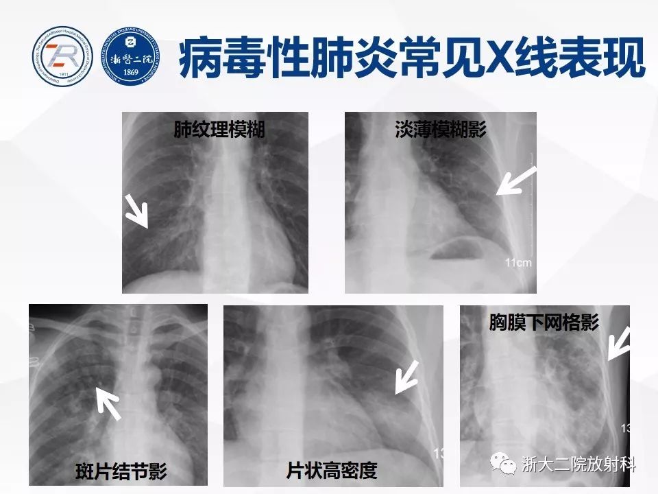 非常重要 | 病毒性肺炎普通x线诊断