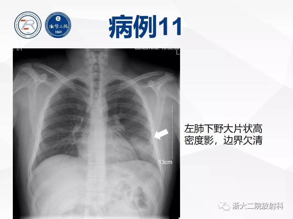 非常重要 | 病毒性肺炎普通x线诊断