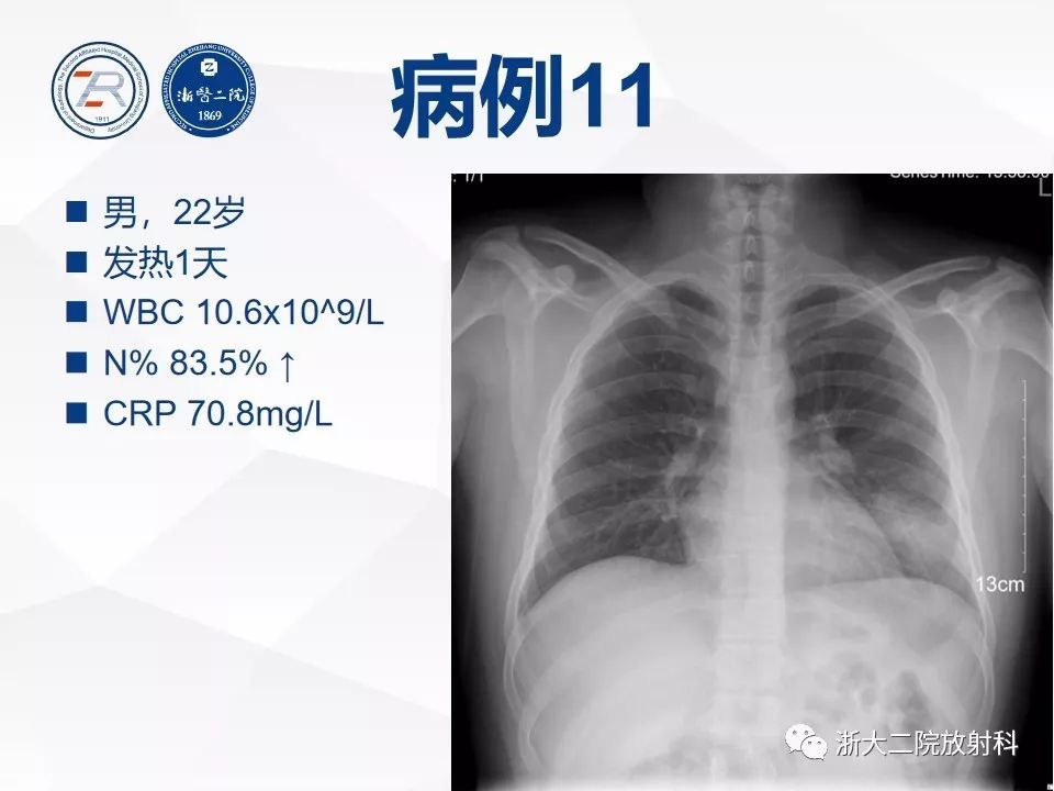 非常重要 | 病毒性肺炎普通x线诊断