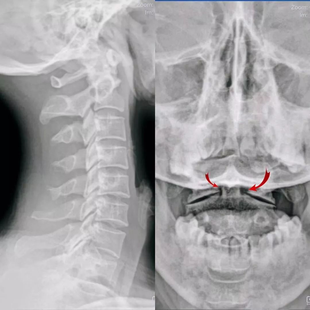 颈椎x线:颈椎生理曲度略变直,齿状突右偏,左侧寰齿间隙明显大于右侧.