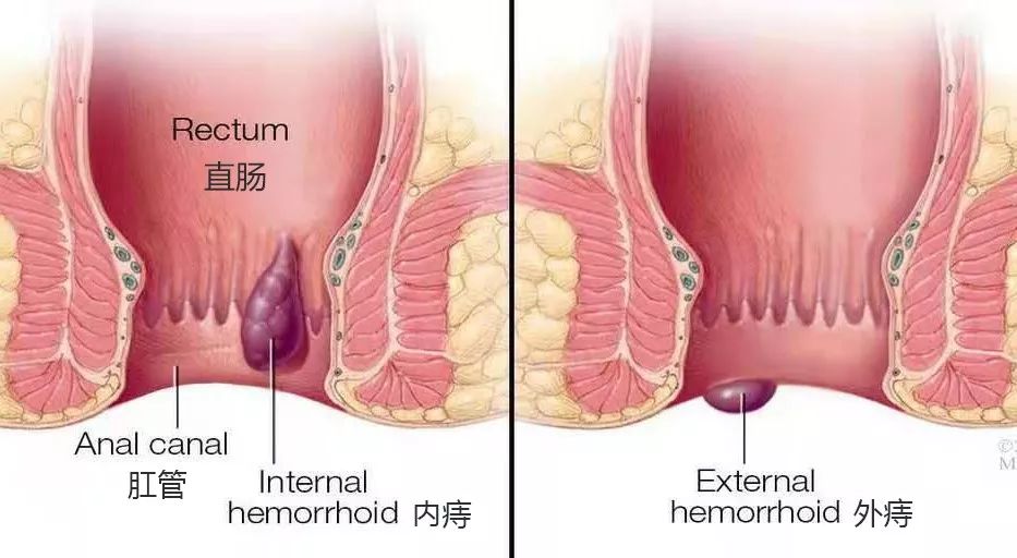 做痔疮手术时放了个屁,崩了医生一脸血.