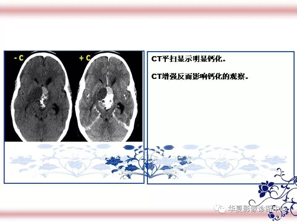 垂体及周围结构解剖与疾病