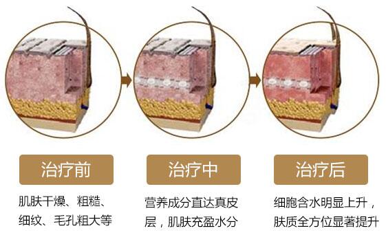 水光针效果能维持多久?