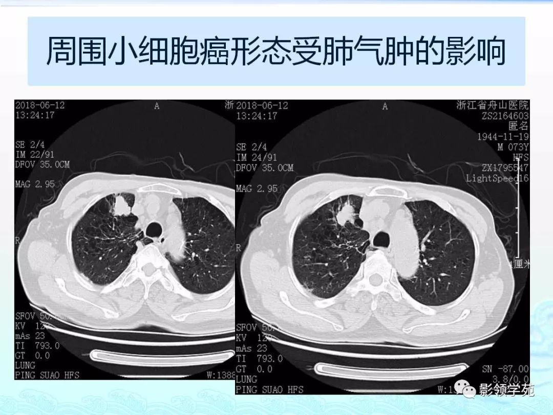 经典小细胞肺癌的病理影像分析