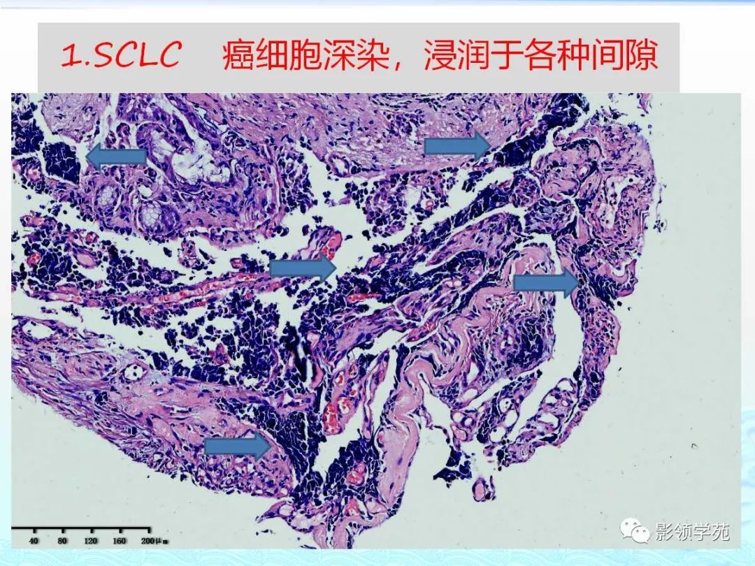 经典小细胞肺癌的病理影像分析