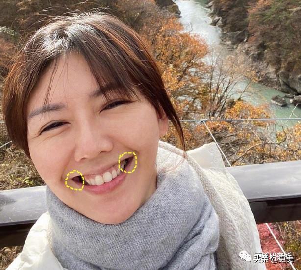 整牙前后的照片,可以看出她整牙后齿颊间隙微微变大,露出的牙齿更加多