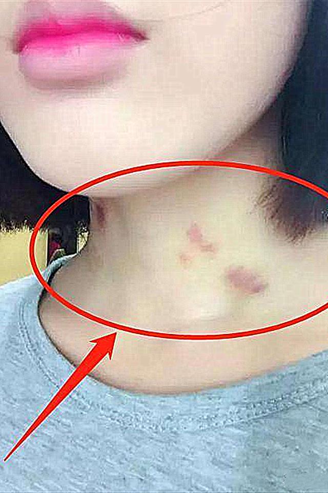 原创12岁女儿脖子出现草莓吻痕爸爸不停逼问孩子的话让人反思