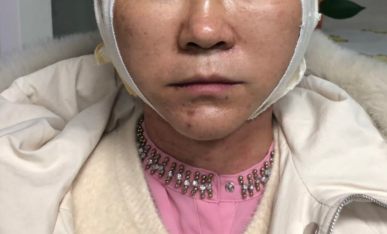 面部拉皮效果怎么样做拉皮手术第七天惊呆众人