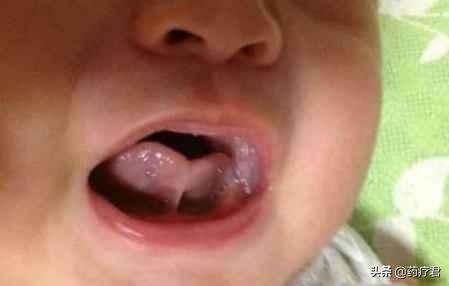 怎么看小孩舌系带 1241ac64a9704805bedb6d77435d947a.jpeg