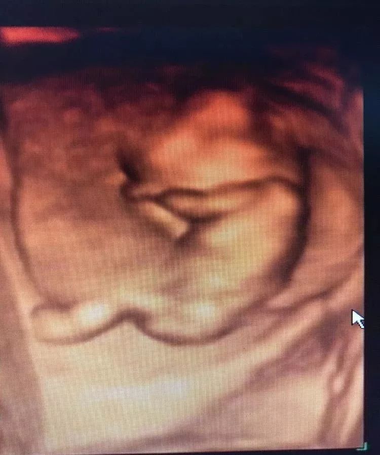 【肥乡妇幼】四维彩超你知道该什么时候做吗?