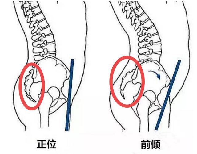 原创腰曲过大就是骨盆前倾?不一定