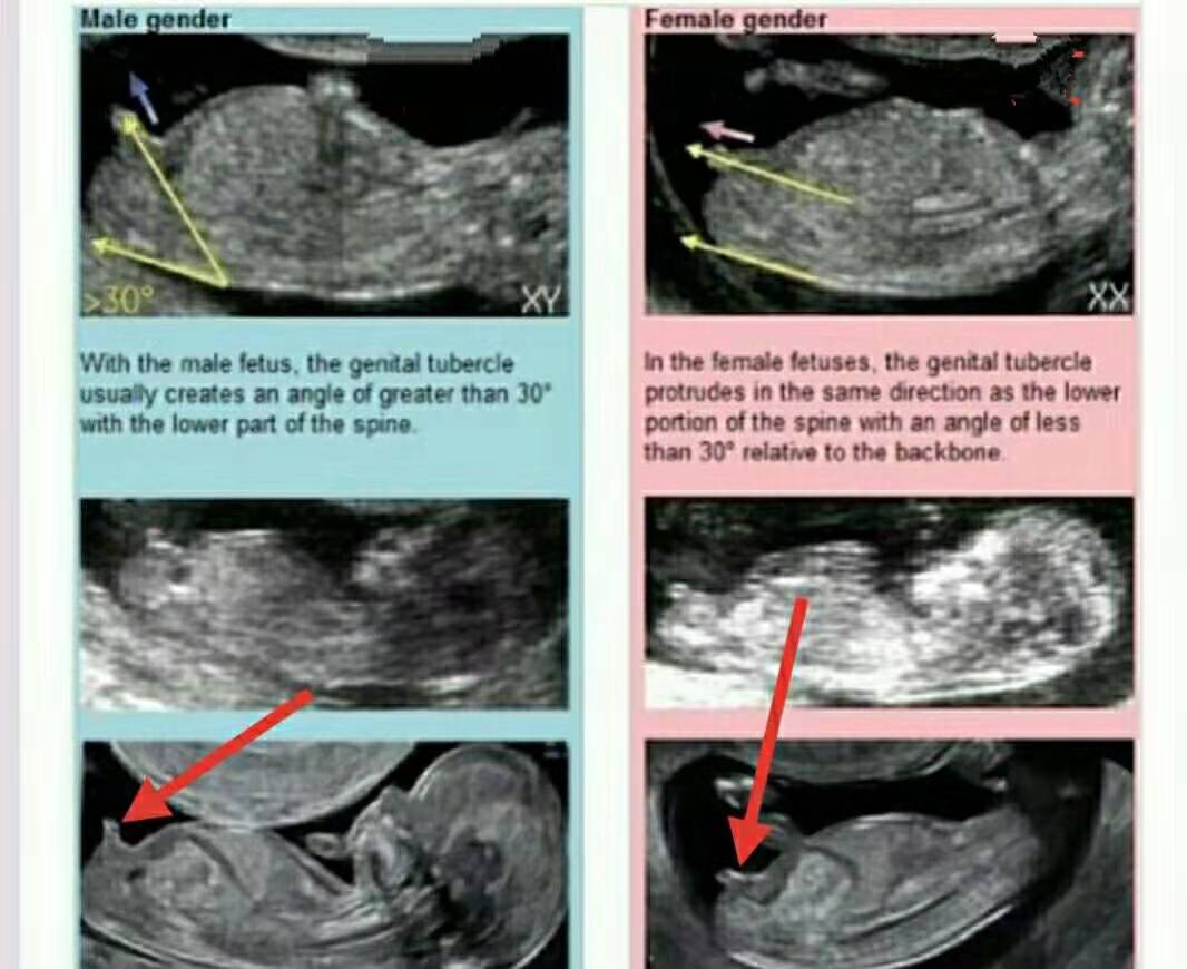 怀孕3个月胎儿变化大：NT图能看胎儿性别？别说，还真有些门道