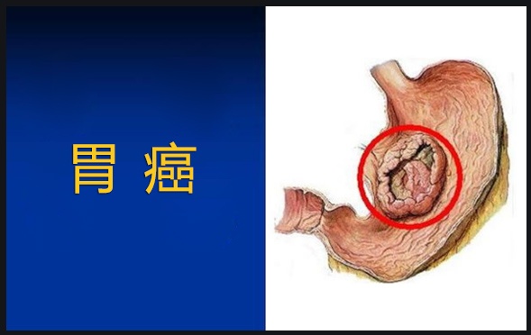 慢性胃炎与消化性溃疡胃癌的清晰鉴别