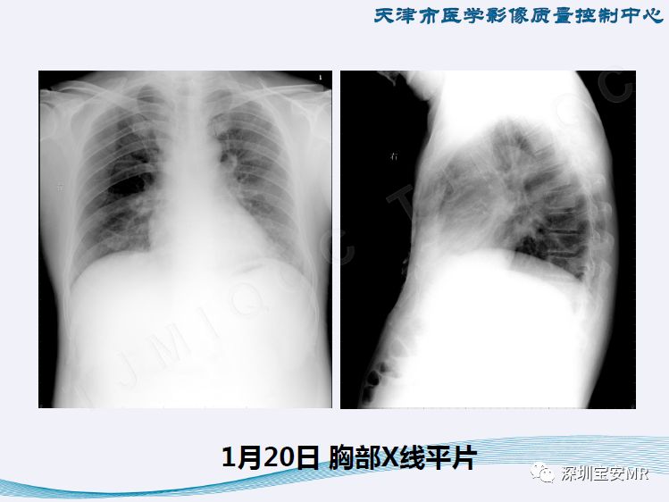 新型冠状病毒感染肺炎影像学表现阶段性总结