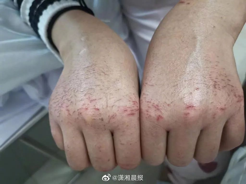 心疼！这是22岁感染科护士的手