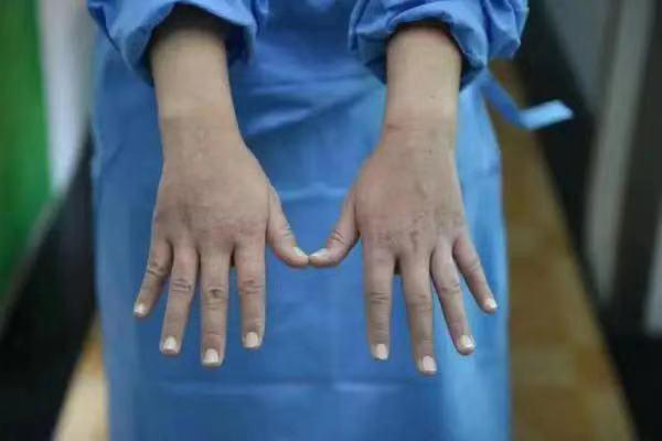 心疼湖南95后护士的手血痕累累抗疫护好自己的皮肤屏障