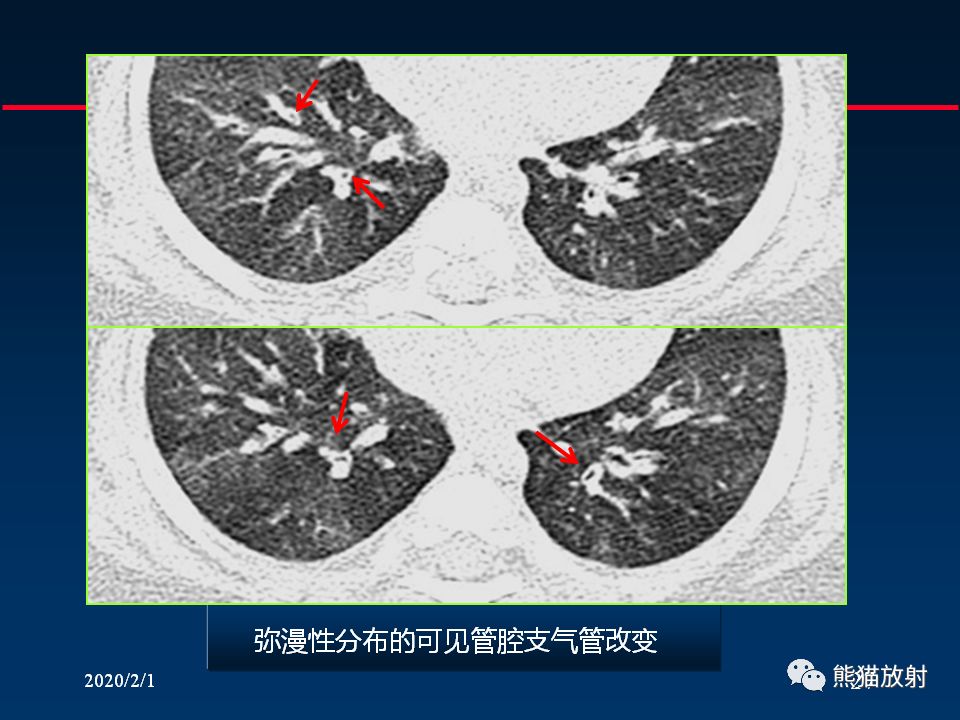 柳澄讲坛丨精准判读支气管感染的基本ct表现