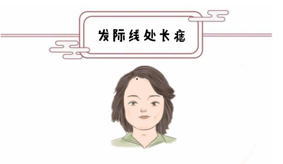 发际线处长痣